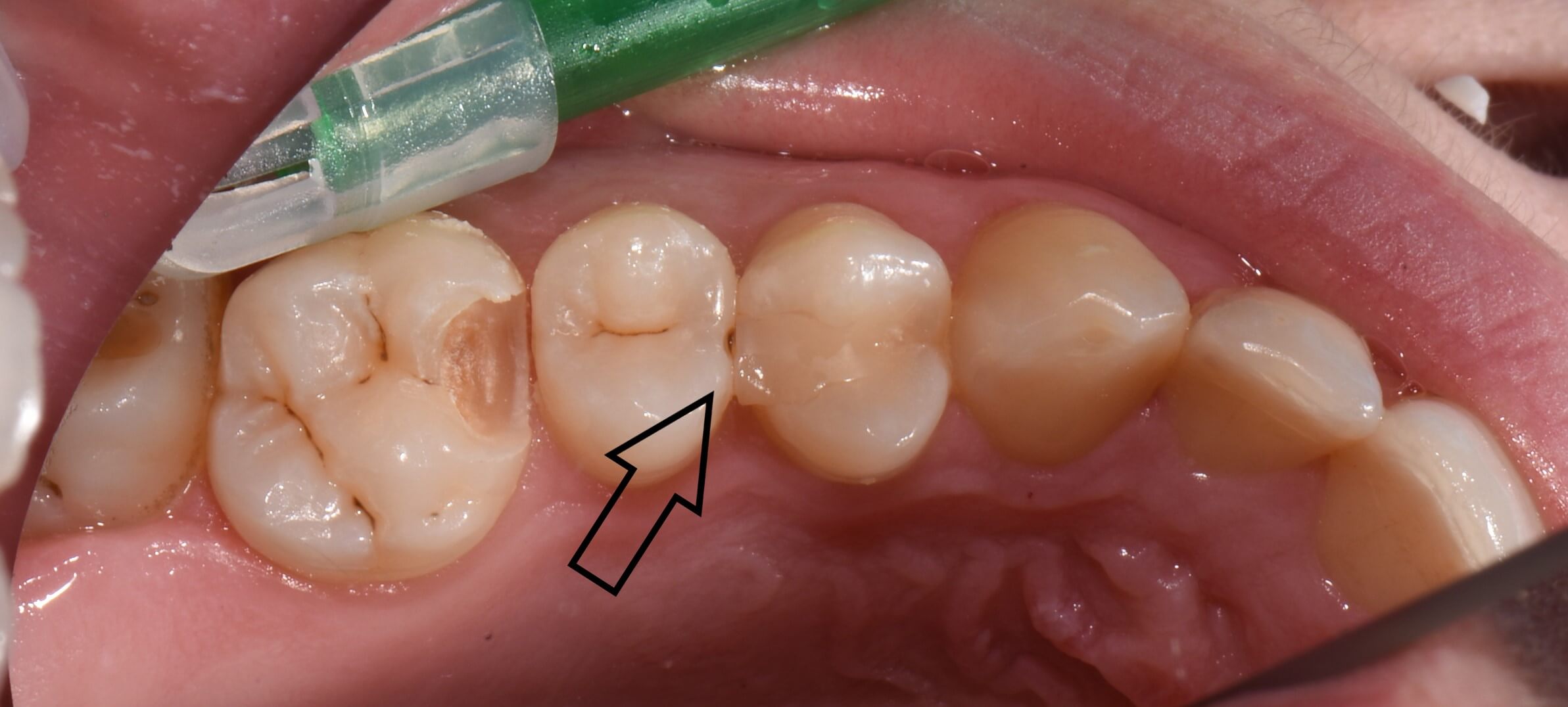 Composite Füllungen